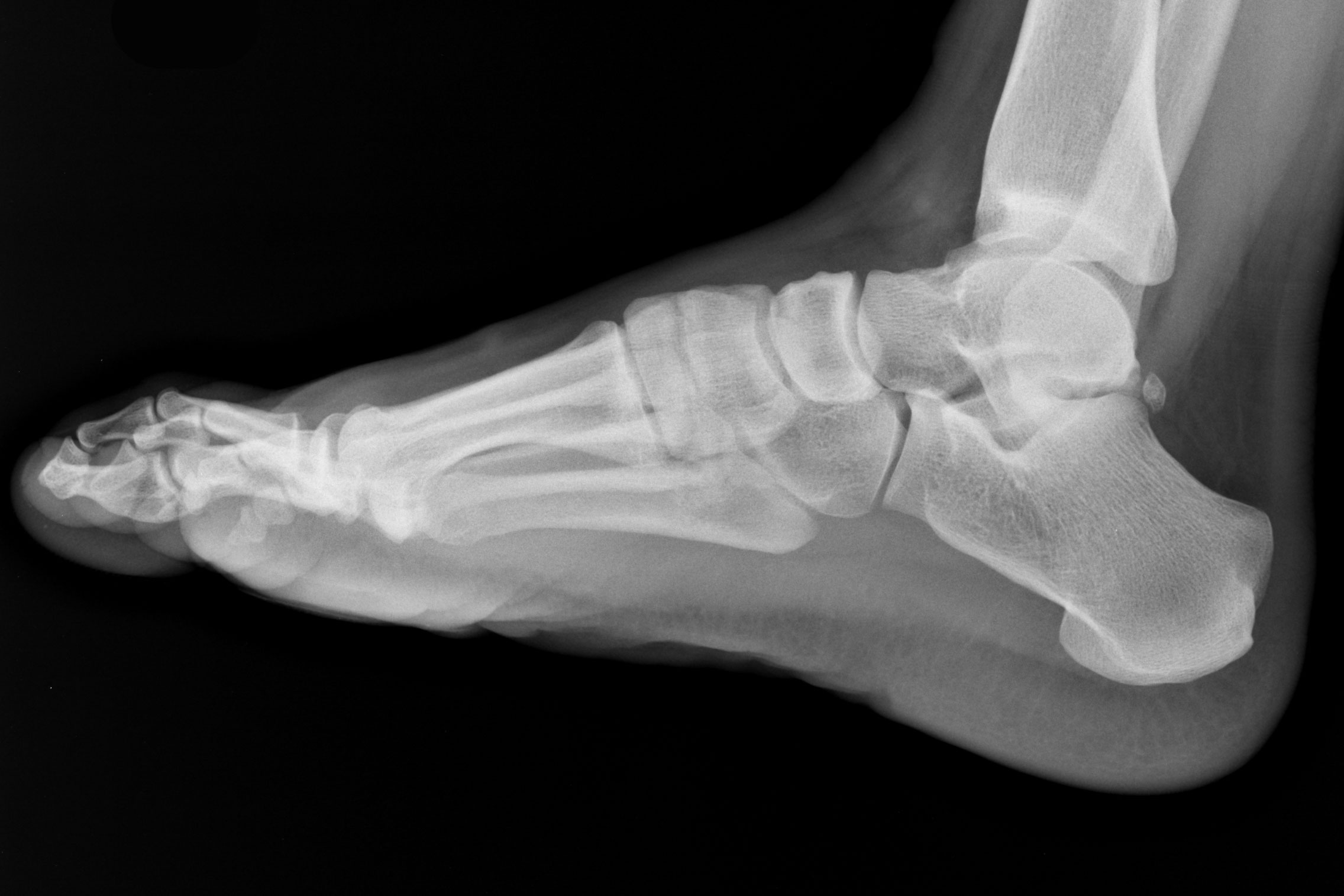 ankle X-ray
