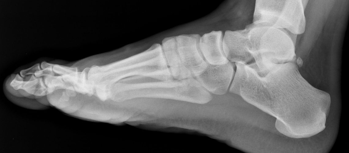 ankle X-ray